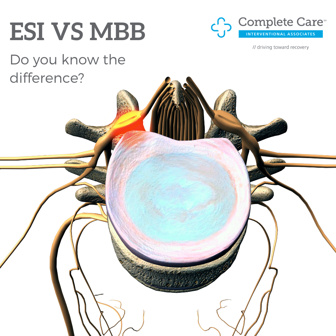 Epidural Steroid Injection vs Medial Branch Block Complete Care